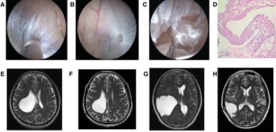 Effect comparison of neuroendoscopic vs. craniotomy in the treatment of adult intracranial arachnoid cyst